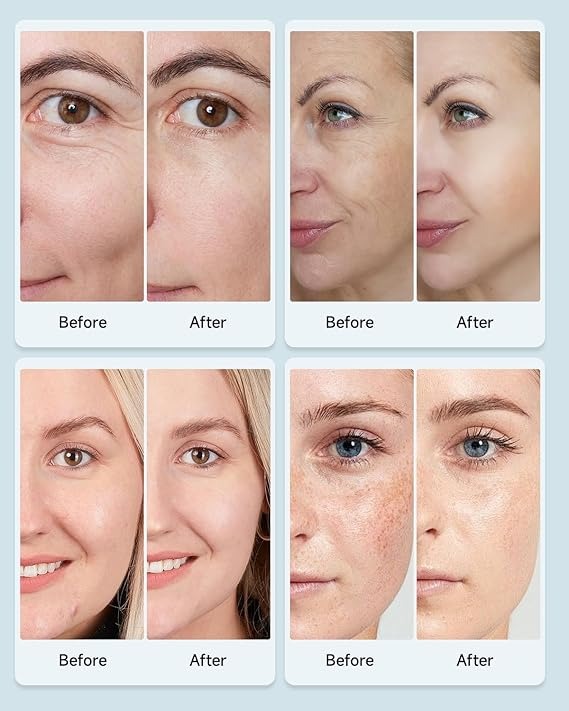PureLuma© Light Therapy Mask